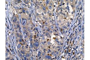 ABIN6262625 and ABIN6268687 at 1/100 staining Human ovarian cancer by IHC-P. (IL2 Receptor beta anticorps  (N-Term))