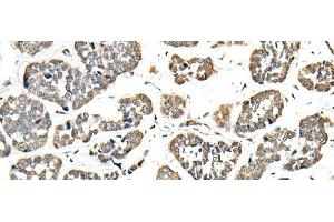 Immunohistochemistry of paraffin-embedded Human esophagus cancer tissue using EEF1E1 Polyclonal Antibody at dilution of 1:35(x200) (EEF1E1 anticorps)