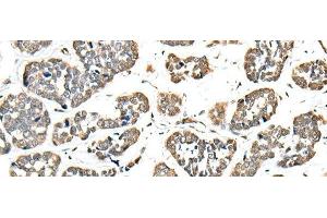 Immunohistochemistry of paraffin-embedded Human esophagus cancer tissue using EEF1E1 Polyclonal Antibody at dilution of 1:35(x200)