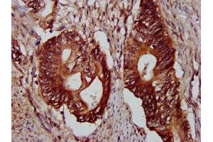 IHC image of ABIN7163687 diluted at 1:300 and staining in paraffin-embedded human colon cancer performed on a Leica BondTM system.