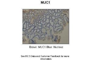 Sample Type :  Human stomach  Primary Antibody Dilution :  1:1000  Secondary Antibody :  Anti-rabbit-HRP  Secondary Antibody Dilution :  1:5000  Color/Signal Descriptions :  Brown: MUC1 Blue: Nucleus  Gene Name :  MUC1  Submitted by :  Dr.