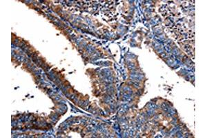 The image on the left is immunohistochemistry of paraffin-embedded Human cervical cancer tissue using ABIN7190708(FPR2 Antibody) at dilution 1/17, on the right is treated with synthetic peptide. (FPR2 anticorps)
