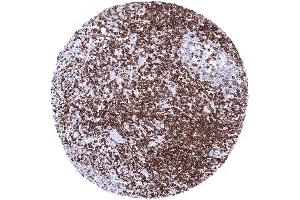 Tonsil Strong CD5 positivity of T lymphocytes interfollicular and in germinal centres