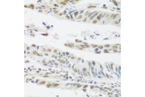 Immunohistochemistry of paraffin-embedded human colon carcinoma using SNAI1 antibody. (SNAIL anticorps)