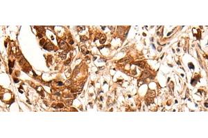 Immunohistochemistry of paraffin-embedded Human gastric cancer tissue using HOXD8 Polyclonal Antibody at dilution of 1:40(x200) (HOXD8 anticorps)