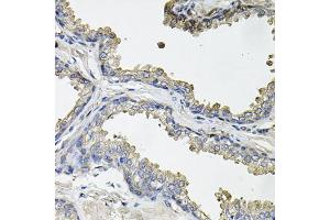 Immunohistochemistry of paraffin-embedded human prostate using ACO1 antibody (ABIN5995389) at dilution of 1/100 (40x lens). (Aconitase 1 anticorps)