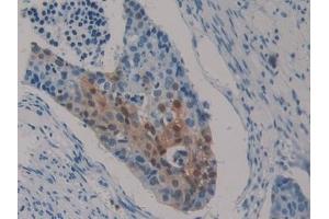 Detection of S100P in Human Lung Tissue using Polyclonal Antibody to S100 Calcium Binding Protein P (S100P)