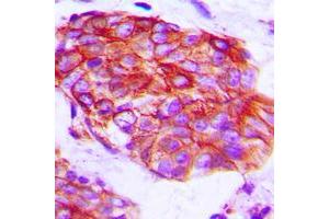 Immunohistochemical analysis of Claudin 6 staining in human prostate cancer formalin fixed paraffin embedded tissue section.