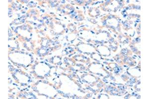 The image on the left is immunohistochemistry of paraffin-embedded Human thyroid cancer tissue using ABIN7128186(ACSM5 Antibody) at dilution 1/35, on the right is treated with fusion protein. (ACSM5 anticorps)