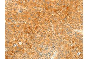 The image on the left is immunohistochemistry of paraffin-embedded Human liver cancer tissue using ABIN7131139(SOCS6 Antibody) at dilution 1/35, on the right is treated with fusion protein. (SOCS6 anticorps)
