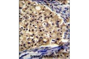 SLC16A13 Antibody (C-term) (ABIN655357 and ABIN2844916) immunohistochemistry analysis in formalin fixed and paraffin embedded human breast carcinoma followed by peroxidase conjugation of the secondary antibody and DAB staining.