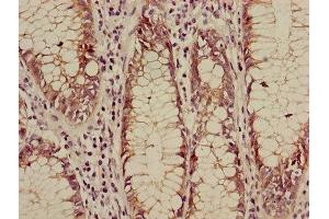 Immunohistochemistry of paraffin-embedded human colon cancer using ABIN7146984 at dilution of 1:100