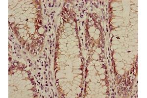 Immunohistochemistry of paraffin-embedded human colon cancer using ABIN7146984 at dilution of 1:100 (CTNNB1 anticorps  (AA 2-781))