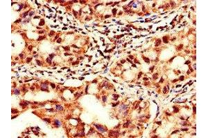 Immunohistochemistry of paraffin-embedded human lung cancer using ABIN7175942 at dilution of 1:100 (YTHDF2 anticorps  (AA 201-500))