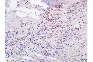 Formalin-fixed and paraffin embedded human lung carcinoma labeled with Anti-CCL5/RANTES Polyclonal Antibody, Unconjugated (ABIN674949) at 1:200 followed by conjugation to the secondary antibody and DAB staining. (CCL5 anticorps  (AA 62-91))
