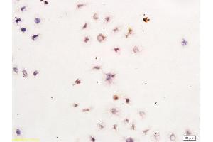 Human Gastric Cancer Cells labeled with Anti-Survivin Polyclonal Antibody, Unconjugated  at 1:300, followed by conjugation to the secondary antibody and DAB staining