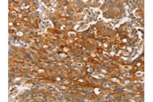The image on the left is immunohistochemistry of paraffin-embedded Human gastic cancer tissue using ABIN7190272(CLDN11 Antibody) at dilution 1/25, on the right is treated with synthetic peptide. (Claudin 11 anticorps)