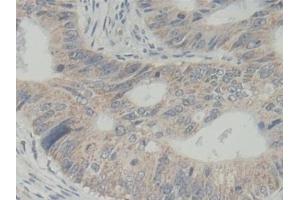 Detection of ABCB5 in Human Colorectal cancer Tissue using Polyclonal Antibody to ATP Binding Cassette Transporter B5 (ABCB5)