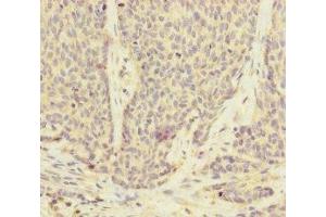 Immunohistochemistry of paraffin-embedded human ovarian cancer using ABIN7175186 at dilution of 1:100