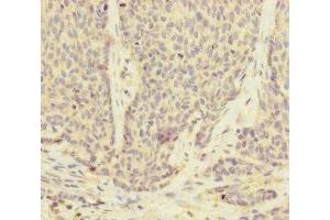 Immunohistochemistry of paraffin-embedded human ovarian cancer using ABIN7175186 at dilution of 1:100 (UACA anticorps  (AA 1-90))