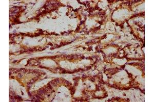 IHC image of ABIN7152685 diluted at 1:293 and staining in paraffin-embedded human colon cancer performed on a Leica BondTM system. (FRMD6 anticorps  (AA 413-622))