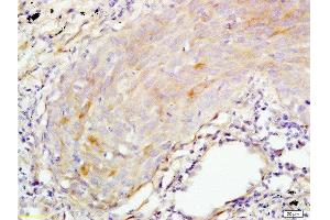 Formalin-fixed and paraffin embedded human lung carcinoma tissue labeled with Anti-S100A7 Polyclonal Antibody, Unconjugated  at 1:200 followed by conjugation to the secondary antibody and DAB staining (S100A7A anticorps  (AA 41-108))