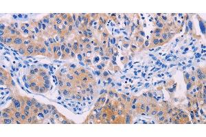 Immunohistochemistry of paraffin-embedded Human lung cancer using AGT Polyclonal Antibody at dilution of 1:30 (AGT anticorps)