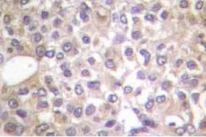 Immunohistochemistry (IHC) analyzes of p-PI3K p85 (pTyr458)/p55 (pTyr199) antibody in paraffin-embedded human breast carcinoma tissue.