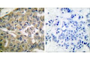 Peptide - +Immunohistochemical analysis of paraffin-embedded human breast carcinoma tissue using FHIT antibody (#C0193). (FHIT anticorps)
