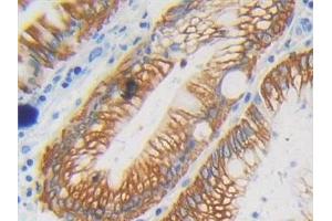 Detection of CYFRA21-1 in Human Colorectal cancer Tissue using Polyclonal Antibody to Cytokeratin Fragment Antigen 21-1 (CYFRA21-1)