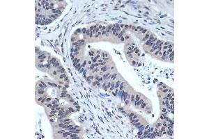 Immunohistochemistry of paraffin-embedded human colon carcinoma using XPD/ERCC2 Rabbit mAb (ABIN7267057) at dilution of 1:100 (40x lens).