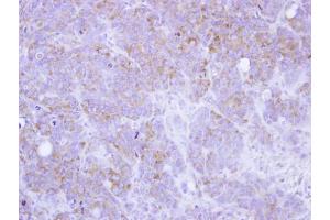 IHC-P Image Immunohistochemical analysis of paraffin-embedded SW480 xenograft, using ST3GAL2, antibody at 1:100 dilution.