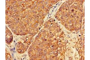 Immunohistochemistry of paraffin-embedded human ovarian cancer using ABIN7162911 at dilution of 1:100