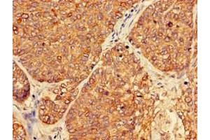 Immunohistochemistry of paraffin-embedded human ovarian cancer using ABIN7162911 at dilution of 1:100 (PER3 anticorps  (AA 1-131))
