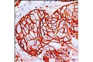 Anti-c-erbB2 Monoclonal Antibody - Immunohistochemistry  Anti-c-erbB2 Monoclonal Antibody (Rabbit) was used to detect c-erbB2 in human breast tumor tissue. (ErbB2/Her2 anticorps  (Extracellular Domain))