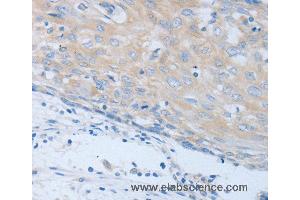 Immunohistochemistry of Human cervical cancer using CHRFAM7A Polyclonal Antibody at dilution of 1:40 (CHRNA7 anticorps)