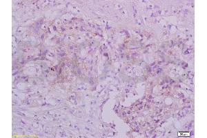 Formalin-fixed and paraffin embedded human gastric carcinoma tissue labeled with Anti-TRAF3/CD40bp Polyclonal Antibody, Unconjugated (ABIN738921) at 1:200 followed by conjugation to the secondary antibody and DAB staining