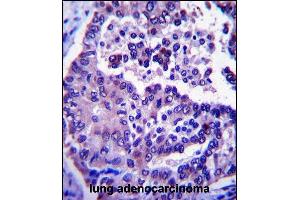 ARL8A Antibody (Center) (ABIN657381 and ABIN2846426) immunohistochemistry analysis in formalin fixed and paraffin embedded human lung adenocarcinoma followed by peroxidase conjugation of the secondary antibody and DAB staining.