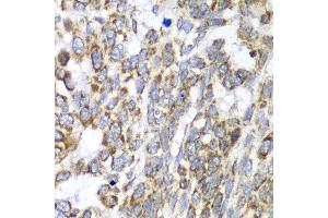 Immunohistochemistry of paraffin-embedded human esophageal cancer using DLST antibody at dilution of 1:100 (x40 lens).