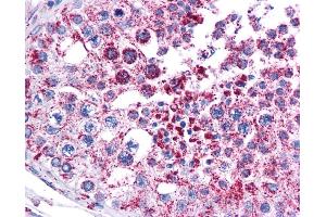 MAGEA3 antibody was used for immunohistochemistry at a concentration of 4-8 ug/ml. (MAGEA3 anticorps  (Middle Region))