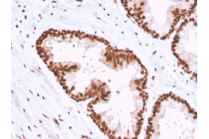 Formalin-fixed, paraffin-embedded human Prostate Carcinoma stained with APEX Nuclease I Mouse Monoclonal Antibody (CPTC-APEX1-2). (SHP1 anticorps)