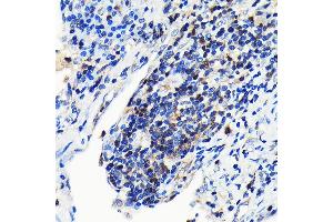 Immunohistochemistry of paraffin-embedded human lung cancer using GRB2 Rabbit mAb (ABIN7267518) at dilution of 1:100 (40x lens).