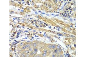 Immunohistochemistry of paraffin-embedded Human gastric cancer using PICK1 Polyclonal Antibody at dilution of 1:100 (40x lens). (PICK1 anticorps)