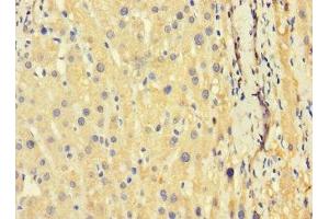 Immunohistochemistry of paraffin-embedded human liver cancer using ABIN7173626 at dilution of 1:100 (TSC22D3 anticorps  (AA 58-134))