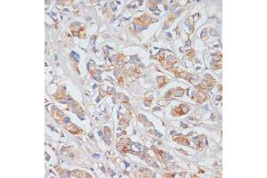 Immunohistochemistry of paraffin-embedded human breast cancer using DLL1 antibody (ABIN7266726) at dilution of 1:100 (40x lens).