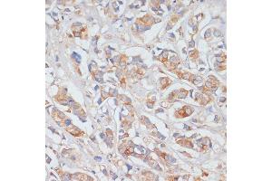 Immunohistochemistry of paraffin-embedded human breast cancer using DLL1 antibody (ABIN7266726) at dilution of 1:100 (40x lens). (DLL1 anticorps  (AA 573-723))