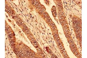 Immunohistochemistry analysis of human colon cancer using ABIN7163605 at dilution of 1:100 (PAFAH1B2 anticorps  (AA 2-229))