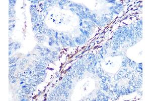 Immunohistochemistry of paraffin-embedded human colon carcinoma using Galectin 1/LG Rabbit mAb (ABIN7268197) at dilution of 1:100 (40x lens). (LGALS1/Galectin 1 anticorps)