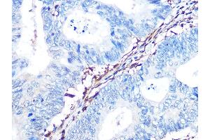 Immunohistochemistry of paraffin-embedded human colon carcinoma using Galectin 1/LG Rabbit mAb (ABIN7268197) at dilution of 1:100 (40x lens).