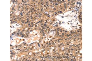 Immunohistochemistry of Human breast cancer using TLN1 Polyclonal Antibody at dilution of 1:35 (TLN1 anticorps)